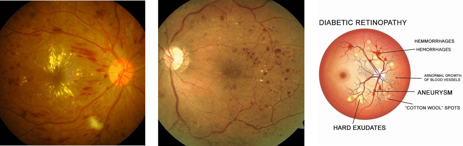 photo - diabetic retinopathy